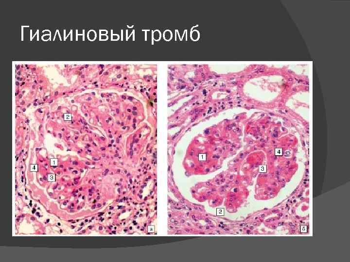 Гиалиновый тромб 