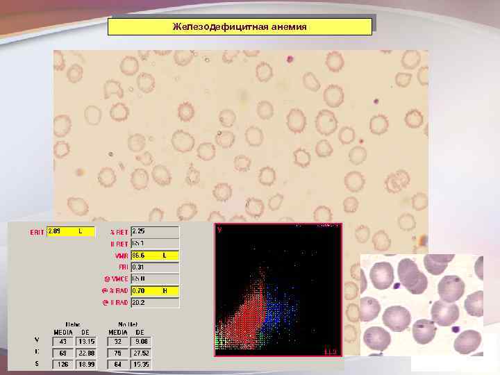 Железодефицитная анемия 