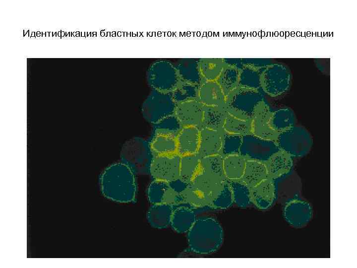 Идентификация бластных клеток методом иммунофлюоресценции 