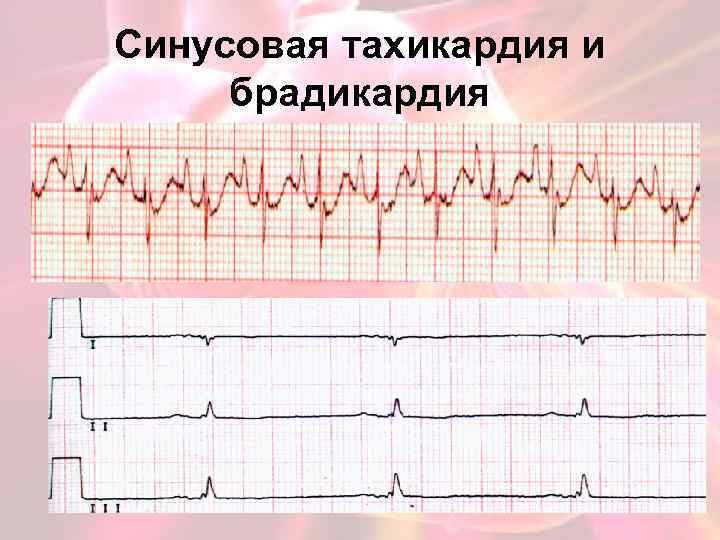 Синусовая тахикардия и брадикардия 