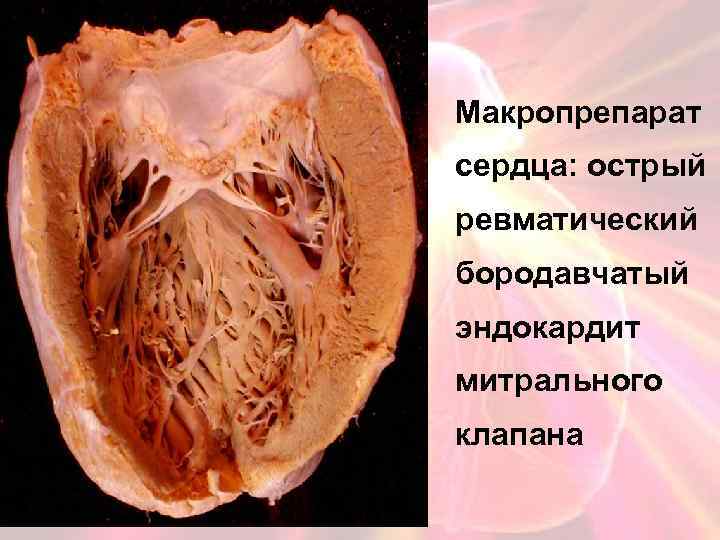 Вегетирующий эндокардит клапана сердца