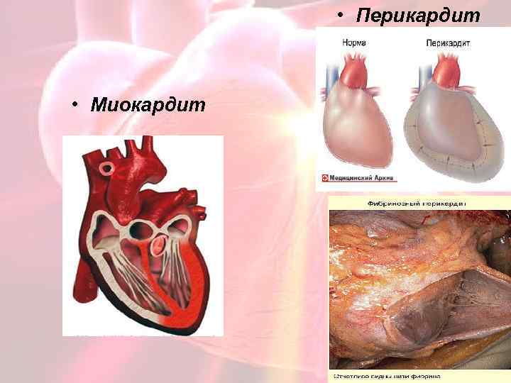  • Перикардит • Миокардит 