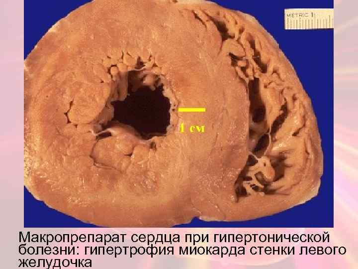 Макропрепарат сердца при гипертонической болезни: гипертрофия миокарда стенки левого желудочка 