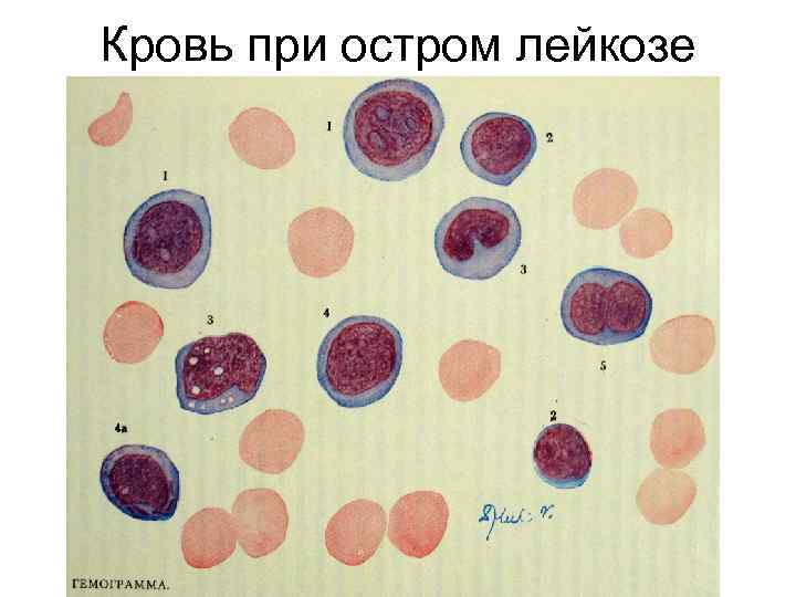 Кровь при остром лейкозе 