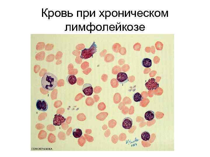 Кровь при хроническом лимфолейкозе 