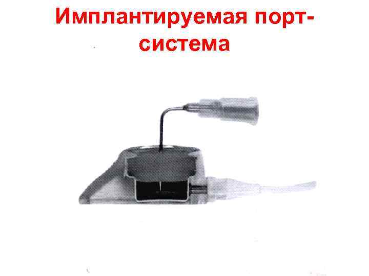 Имплантируемая портсистема 