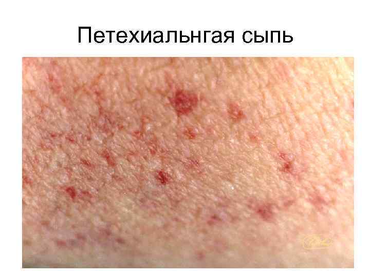 Петехиальнгая сыпь 
