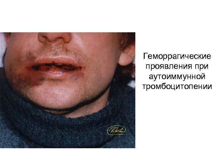 Геморрагические проявления при аутоиммунной тромбоцитопении 