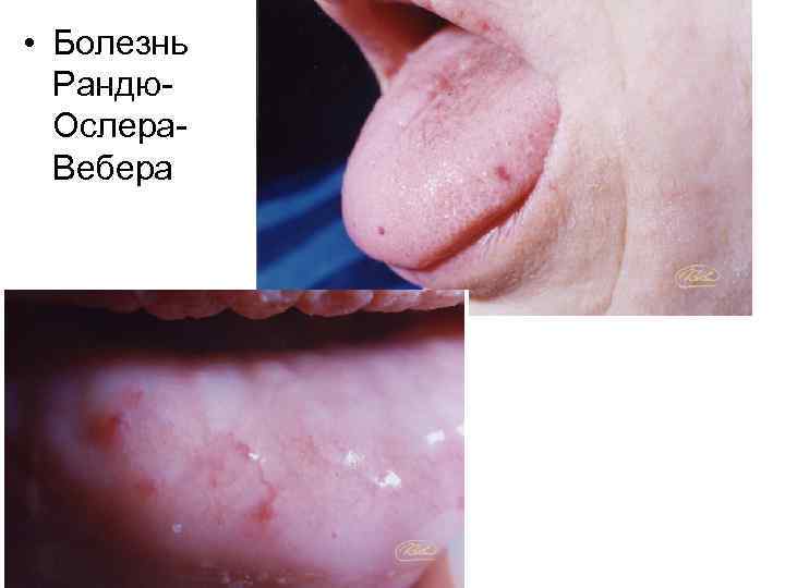  • Болезнь Рандю. Ослера. Вебера 