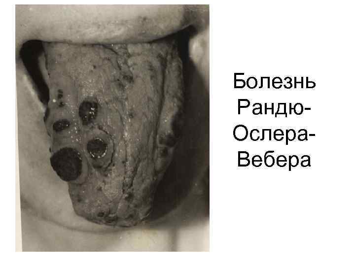 Болезнь Рандю. Ослера. Вебера 