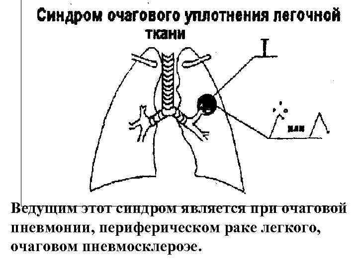 Ведущим этот синдром является при очаговой пневмонии, периферическом раке легкого, очаговом пневмосклероэе. 