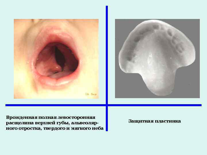 Врожденная полная левосторонняя расщелина верхней губы, альвеолярного отростка, твердого и мягкого неба Защитная пластинка