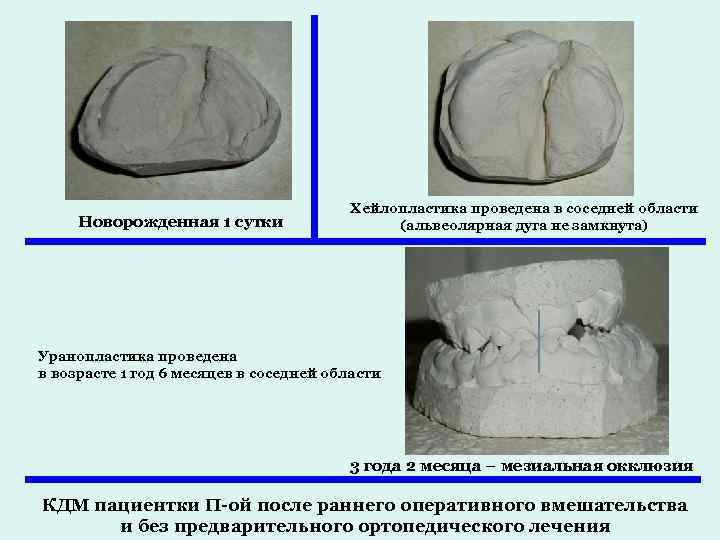 Новорожденная 1 сутки Хейлопластика проведена в соседней области (альвеолярная дуга не замкнута) Уранопластика проведена