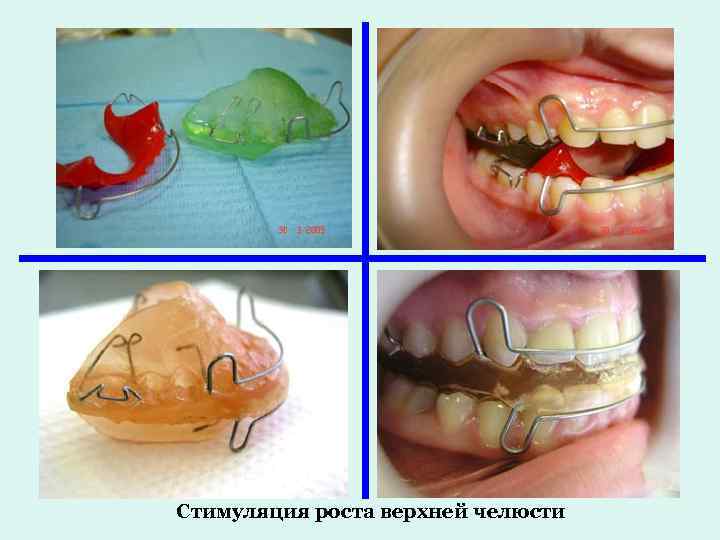 Стимуляция роста верхней челюсти 