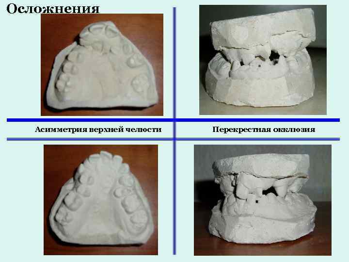 Осложнения Асимметрия верхней челюсти Перекрестная окклюзия 