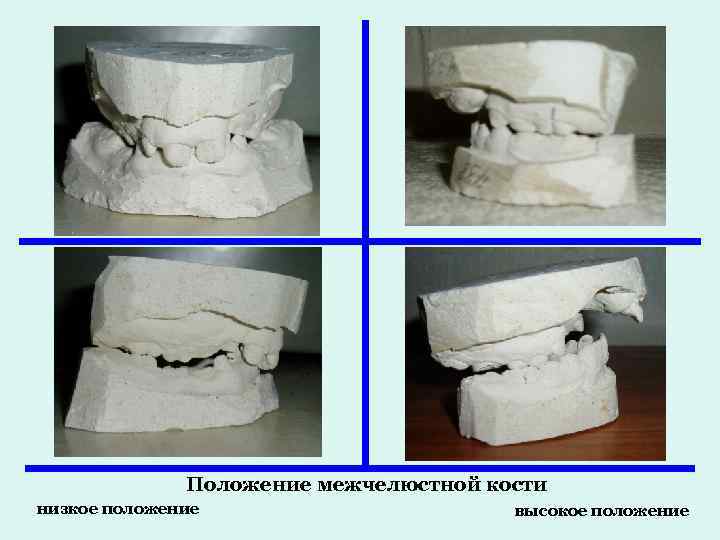 Положение межчелюстной кости низкое положение высокое положение 