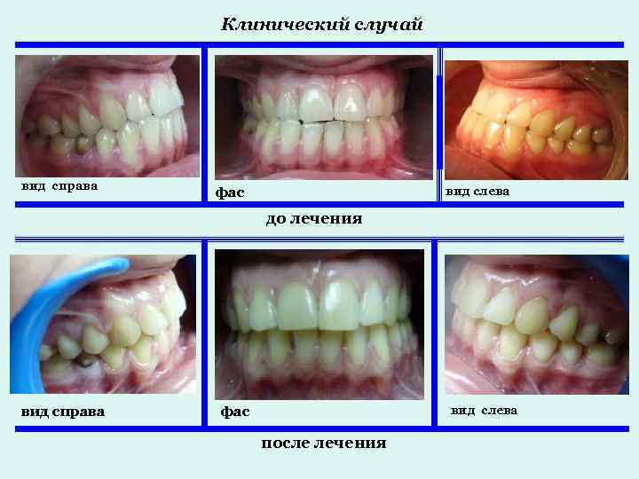 Клинический случай вид справа вид слева фас до лечения вид справа вид слева фас