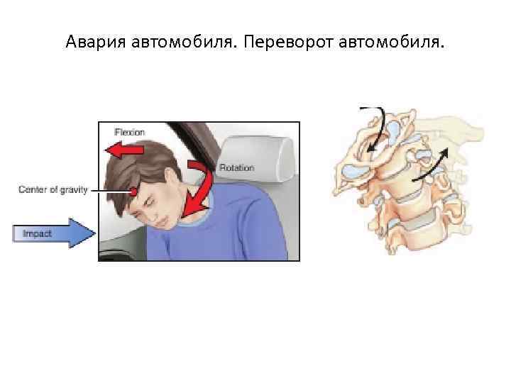Авария автомобиля. Переворот автомобиля. 