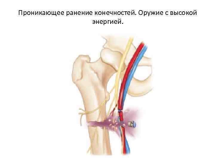 Проникающее ранение конечностей. Оружие с высокой энергией. 