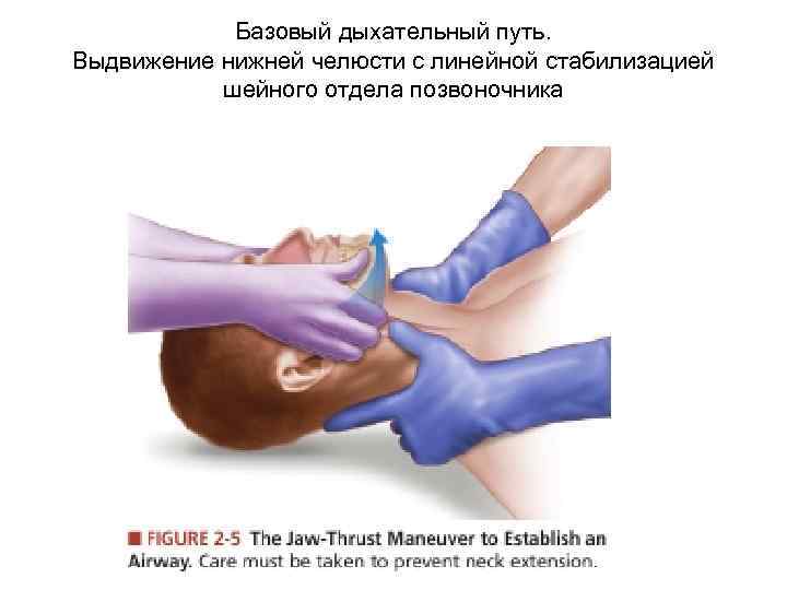 Базовый дыхательный путь. Выдвижение нижней челюсти с линейной стабилизацией шейного отдела позвоночника 