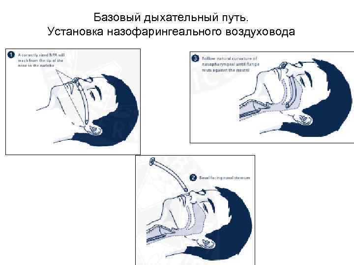 Базовый дыхательный путь. Установка назофарингеального воздуховода 