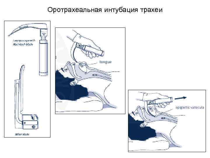 Оротрахеальная интубация трахеи 