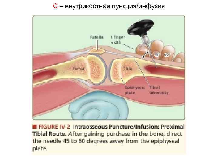 C – внутрикостная пункция/инфузия 