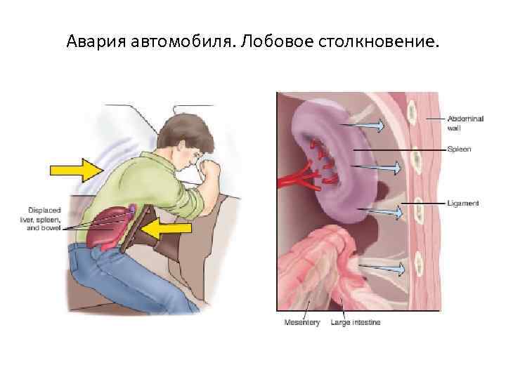 Авария автомобиля. Лобовое столкновение. 