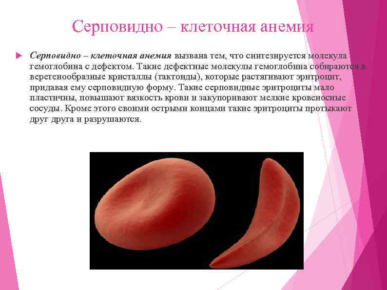 Серповидно – клеточная анемия вызвана тем, что синтезируется молекула гемоглобина с дефектом. Такие дефектные
