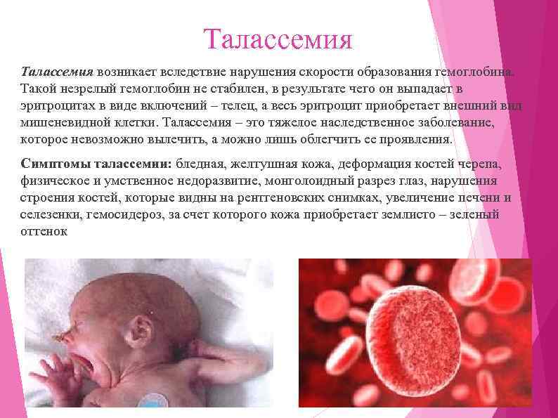 Талассемия возникает вследствие нарушения скорости образования гемоглобина. Такой незрелый гемоглобин не стабилен, в результате
