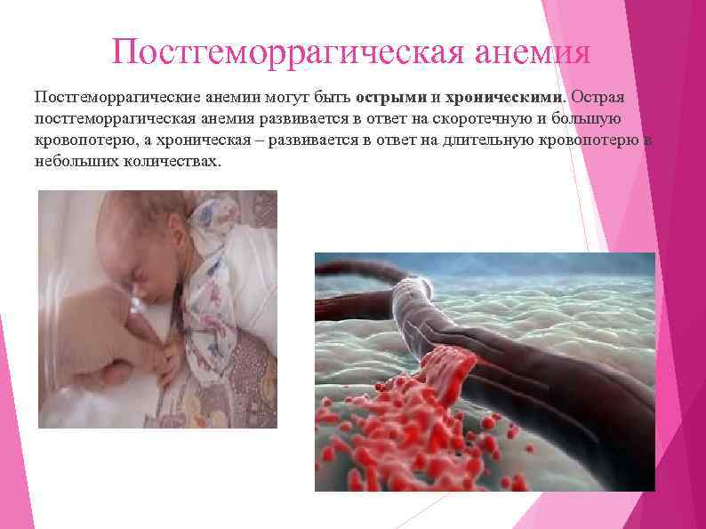 Постгеморрагическая анемия Постгеморрагические анемии могут быть острыми и хроническими. Острая постгеморрагическая анемия развивается в