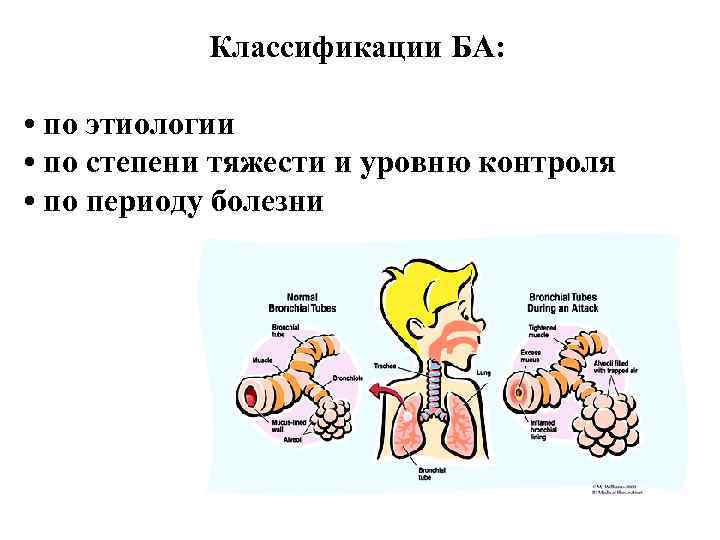 Классификации БА: • по этиологии • по степени тяжести и уровню контроля • по