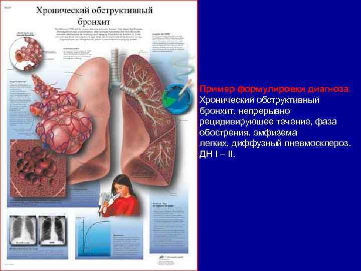 Пример формулировки диагноза: Хронический обструктивный бронхит, непрерывно рецидивирующее течение, фаза обострения, эмфизема легких, диффузный