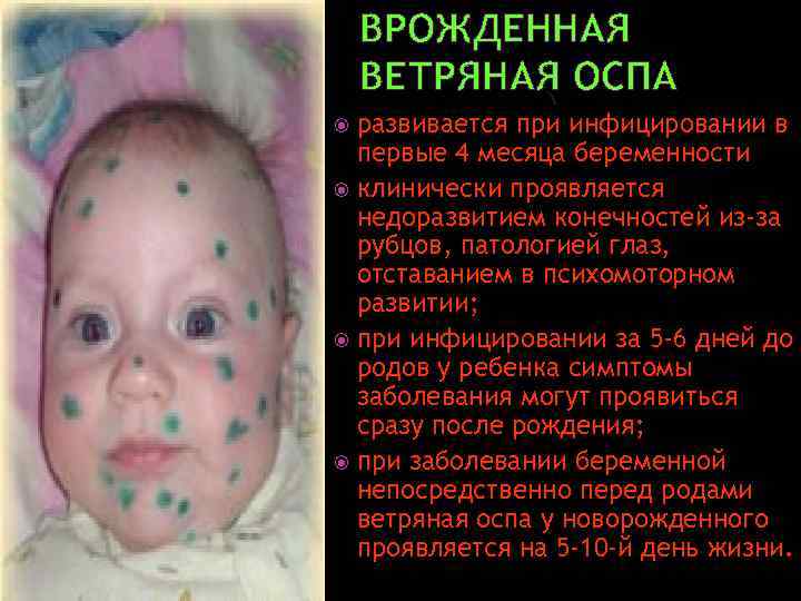 ВРОЖДЕННАЯ ВЕТРЯНАЯ ОСПА развивается при инфицировании в первые 4 месяца беременности клинически проявляется недоразвитием