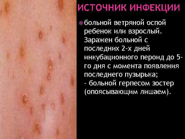 ИСТОЧНИК ИНФЕКЦИИ больной ветряной оспой ребенок или взрослый. Заражен больной с последних 2 -х