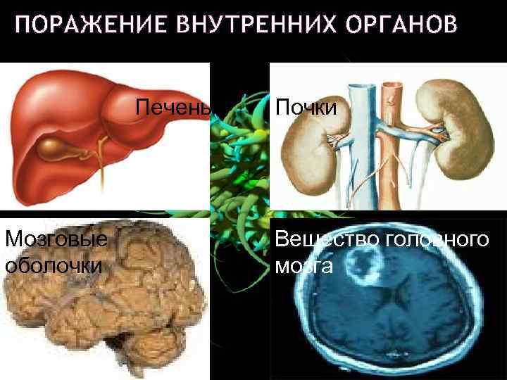 ПОРАЖЕНИЕ ВНУТРЕННИХ ОРГАНОВ Печень Мозговые оболочки Почки Вещество головного мозга 