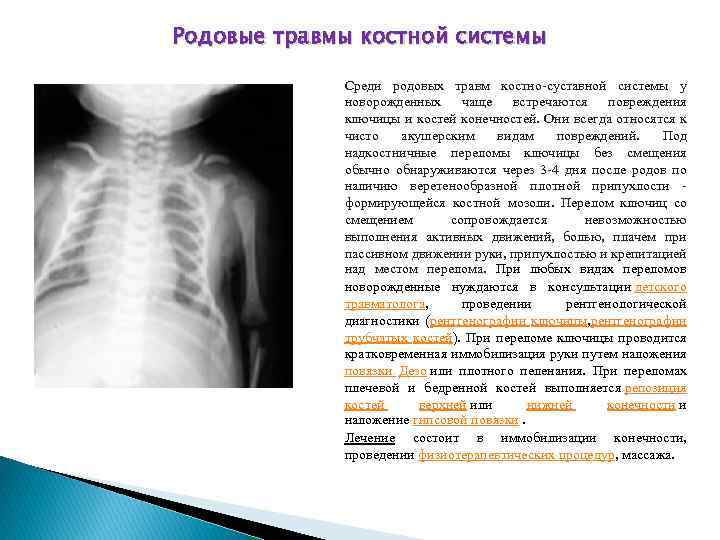 Родовые травмы костной системы Среди родовых травм костно-суставной системы у новорожденных чаще встречаются повреждения