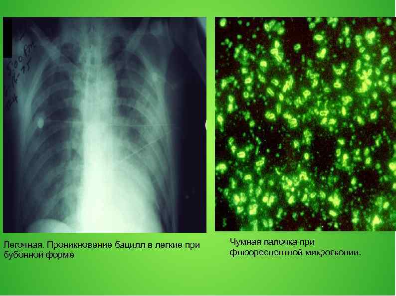 Легочная. Проникновение бацилл в легкие при бубонной форме Чумная палочка при флюоресцентной микроскопии. 
