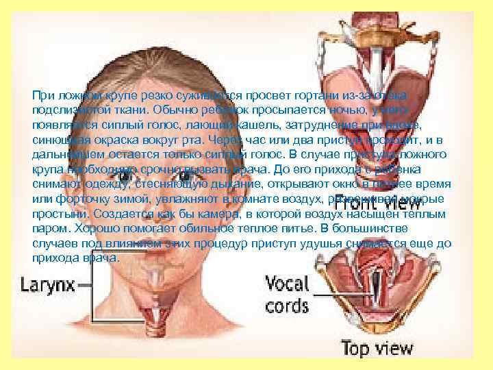 При ложном крупе резко суживается просвет гортани из-за отека подслизистой ткани. Обычно ребенок просыпается