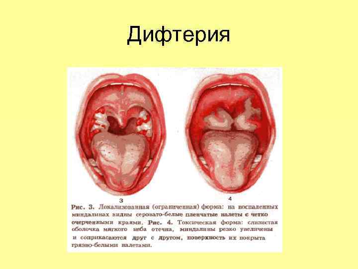 Дифтерия 