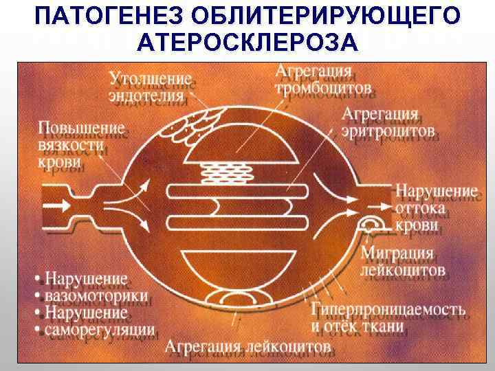 ПАТОГЕНЕЗ ОБЛИТЕРИРУЮЩЕГО АТЕРОСКЛЕРОЗА Сужение просвета атероматозной бляшкой Снижение перфузионного давления ниже уровня стеноза Исчезновение