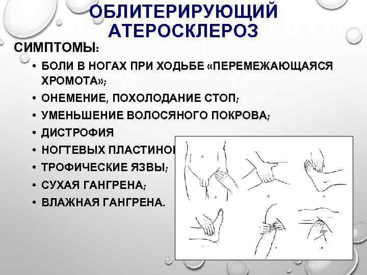 ОБЛИТЕРИРУЮЩИЙ АТЕРОСКЛЕРОЗ СИМПТОМЫ: • БОЛИ В НОГАХ ПРИ ХОДЬБЕ «ПЕРЕМЕЖАЮЩАЯСЯ ХРОМОТА» ; • ОНЕМЕНИЕ,