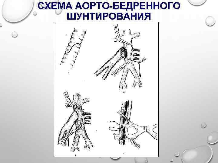 СХЕМА АОРТО-БЕДРЕННОГО ШУНТИРОВАНИЯ 