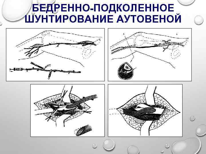 БЕДРЕННО-ПОДКОЛЕННОЕ ШУНТИРОВАНИЕ АУТОВЕНОЙ 