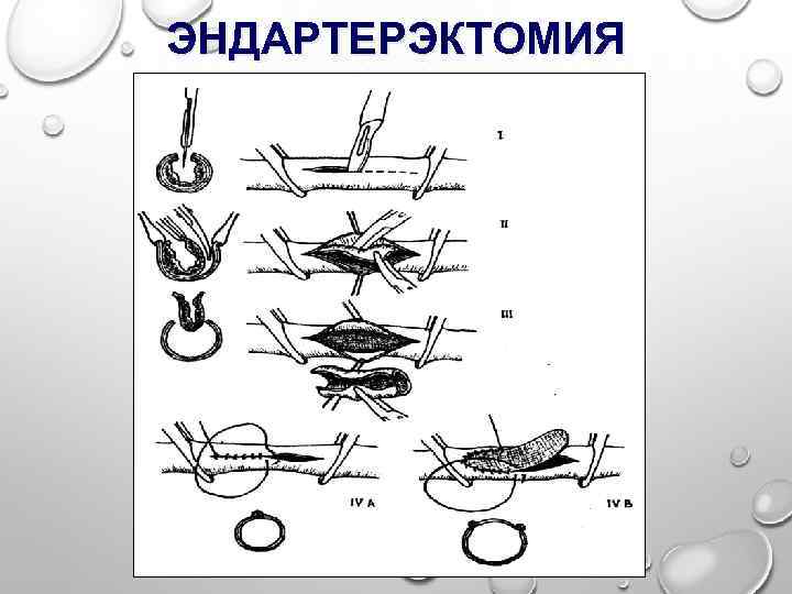 ЭНДАРТЕРЭКТОМИЯ 