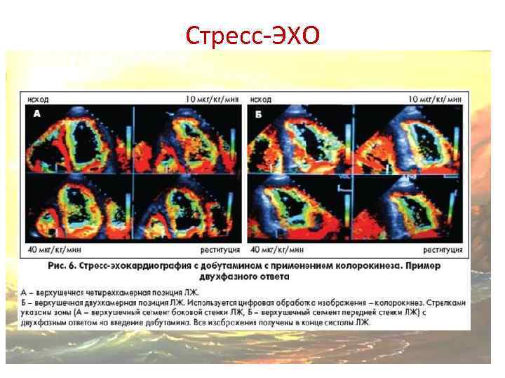 Стресс эхокг презентация