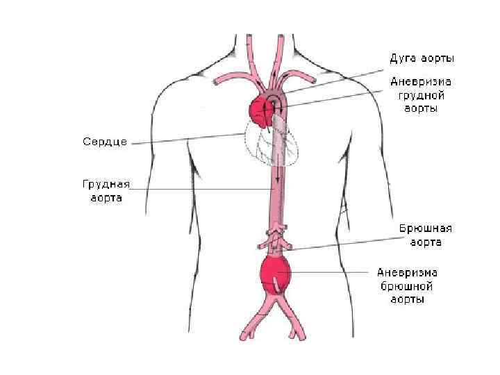 Атеросклероз брюшного. Разрыв брюшной аорты симптомы. Аневризма грудного отдела аорты симптомы разрыв. Аневризма брюшной аорты разрыв. Аневризма брюшной отдел аорты отделы.