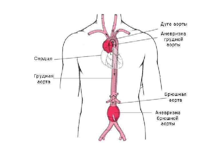 Склероз аорты сердца что. Разрыв брюшной аорты симптомы. Аневризма грудного отдела аорты симптомы разрыв. Аневризма брюшной аорты разрыв. Аневризма брюшной отдел аорты отделы.
