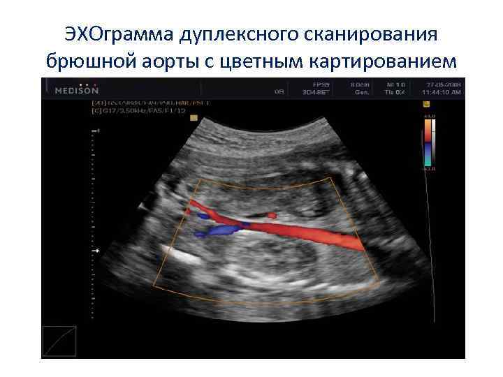 Аневризма брюшной аорты узи признаки и фото с описанием