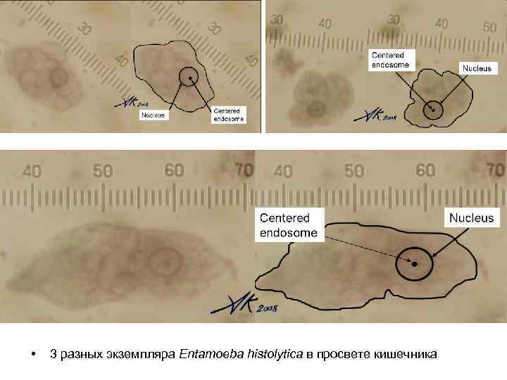  • 3 разных экземпляра Entamoeba histolytica в просвете кишечника 